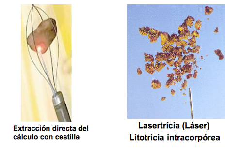 Lasertricia