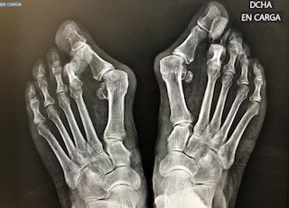 Halluxvalgusbilateral