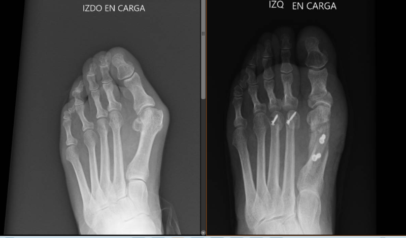 Hallux_valgus_despues_intervencion